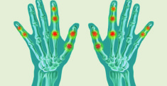 Rheumatoid arthritis a kézben